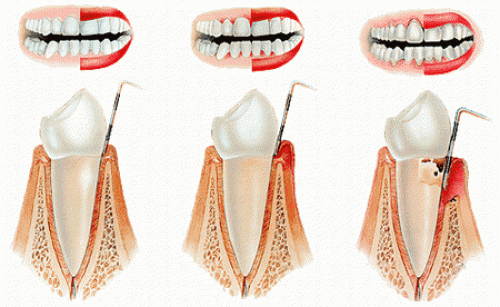 Tandkottsinflammation